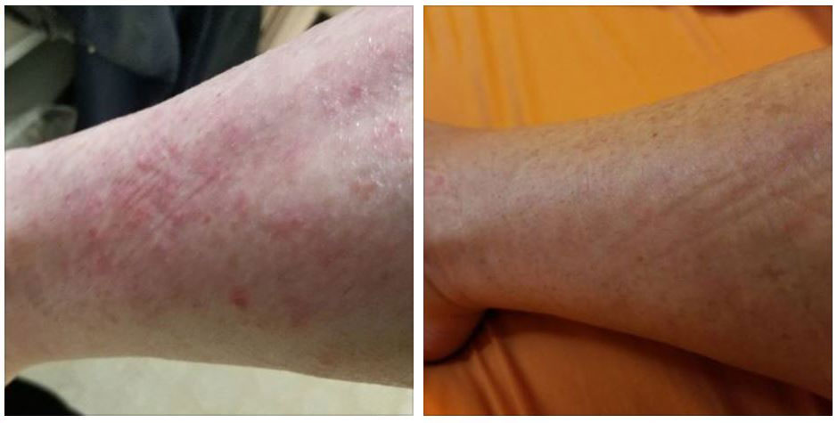 A Case of Psoriasis: 28-Year Struggle